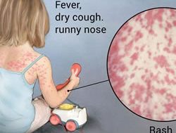 Health warning as measles spotted