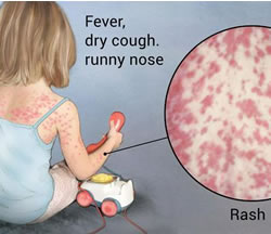 Health warning as measles spotted