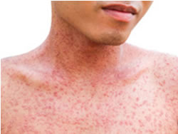 Warning breaks out on measles