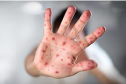 Health breaks out with measles warning