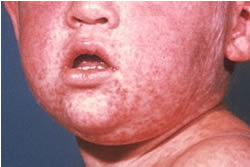 Measles warning as carrier spotted