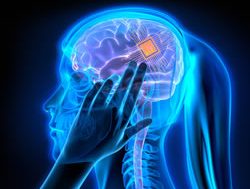 High tech health: Brain implants for depression