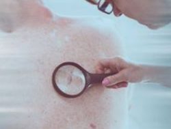 Melanoma research to focus on skin