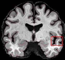 Machine learning: Advancing Alzheimer’s research