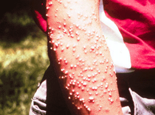 Pustules resulting from fire ant stings on a human arm.